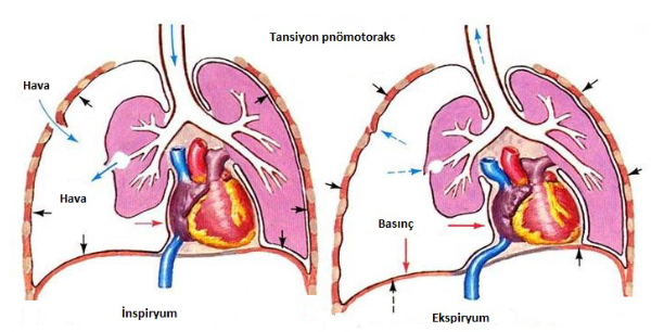 Emici göğüs yaralanması nedeniyle ortaya çıkan tansiyon pnomotoraks