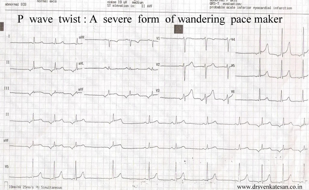 Wandering Atriyal Pacemaker